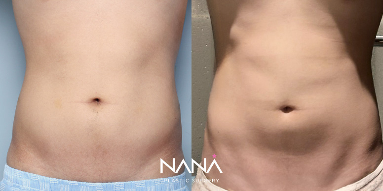 Liposuction Before & After — Before & After