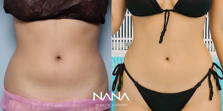 Liposuction Before & After — Before & After