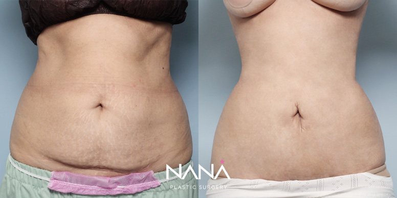 Liposuction Before & After — Before & After