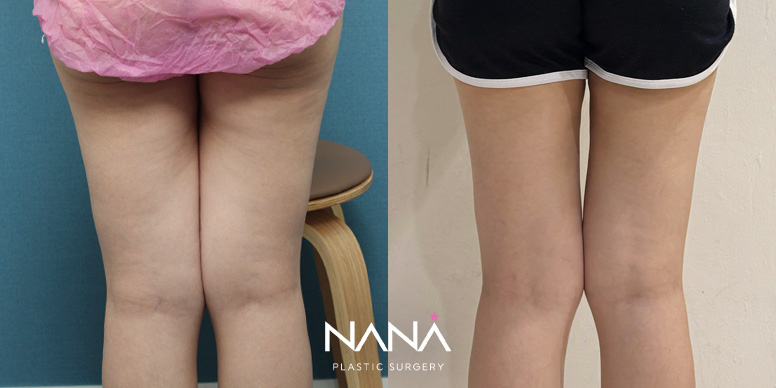 Before & After Before & After