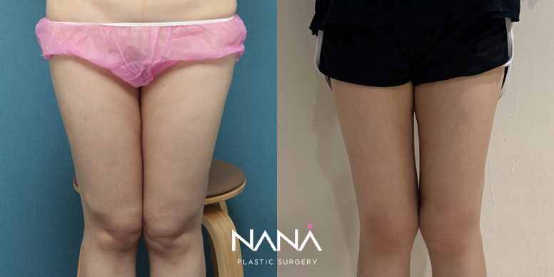 Liposuction Before & After — Before & After