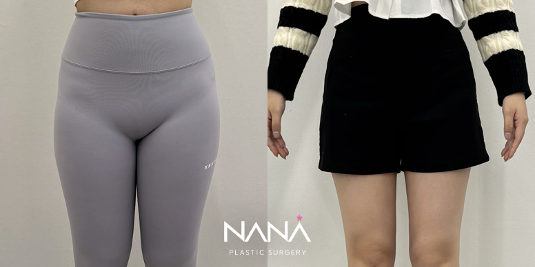 Liposuction Before & After — Before & After