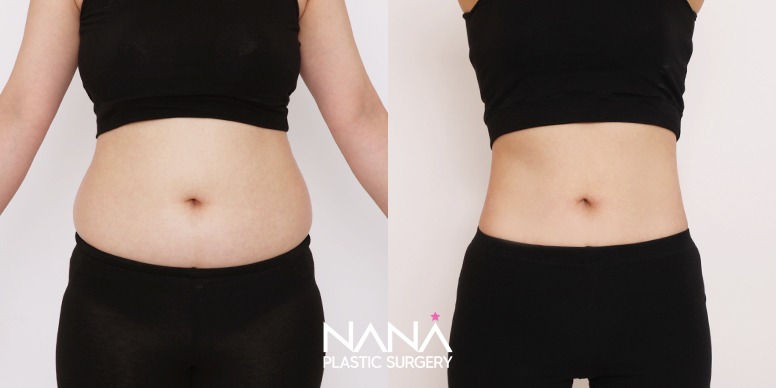 Liposuction Before & After — Before & After