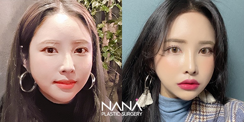 Liposuction Before & After — Before & After