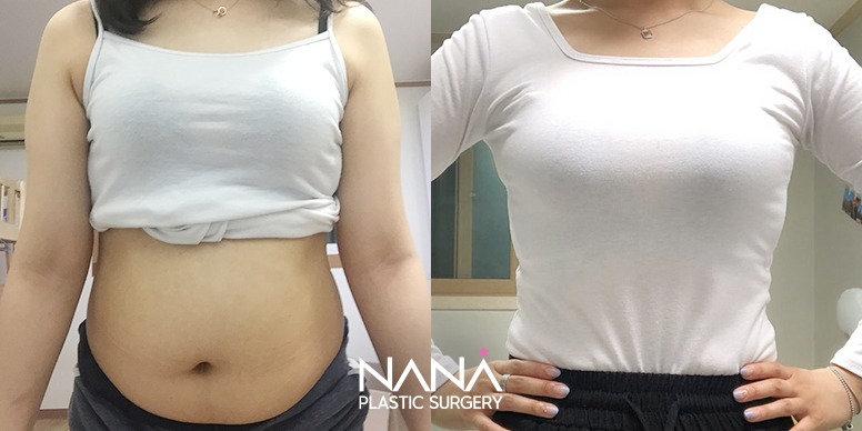 Liposuction Before & After — Before & After