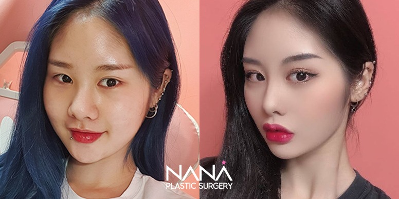 Liposuction Before & After — Before & After