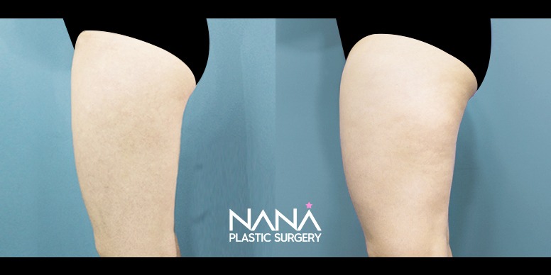 Liposuction Before & After — Before & After