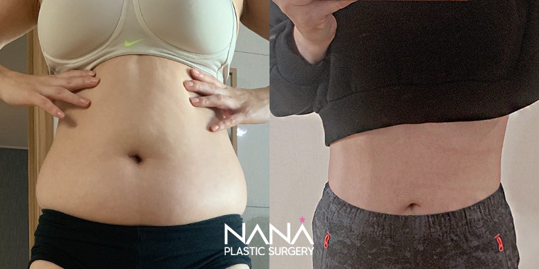 Liposuction Before & After — Before & After