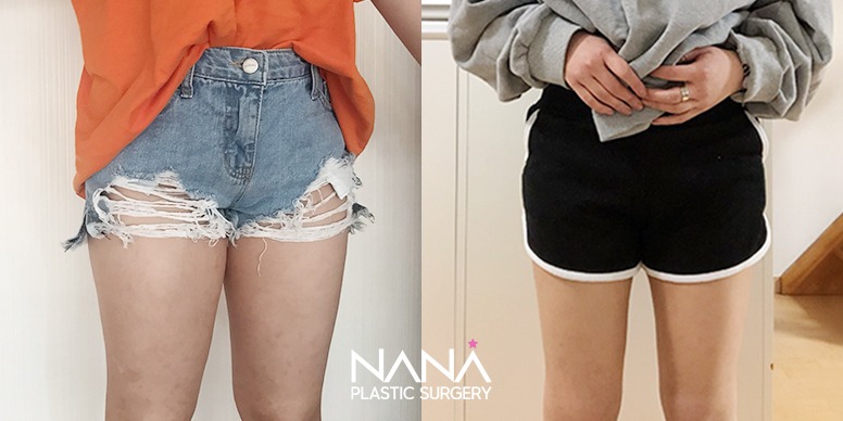 Liposuction Before & After — Before & After