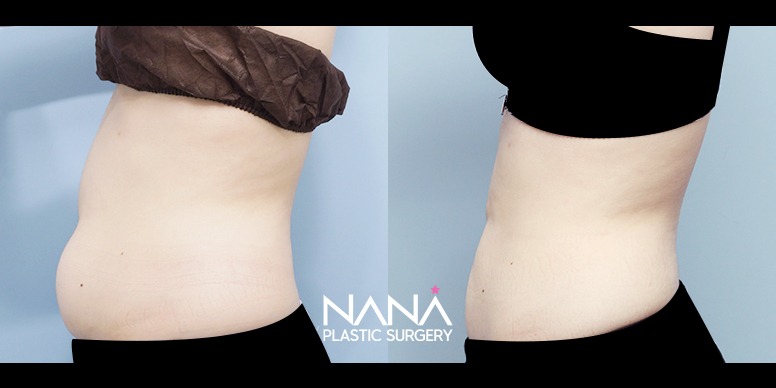 Liposuction Before & After — Before & After