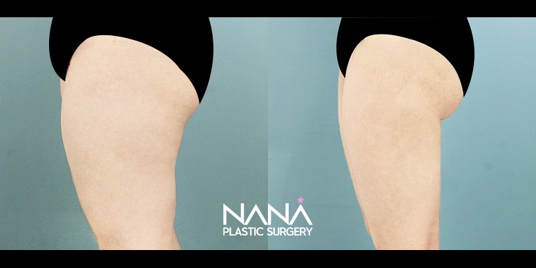 Liposuction Before & After — Before & After
