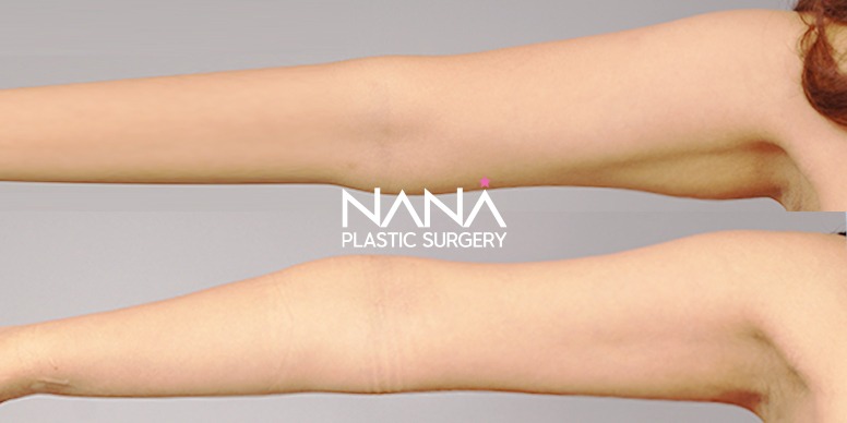 Liposuction Before & After — Before & After