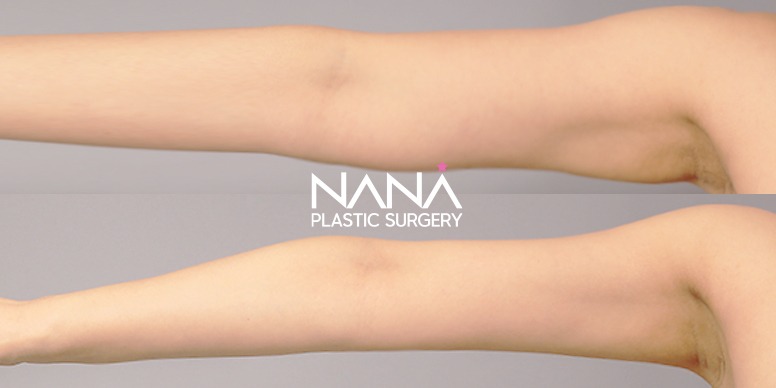 Liposuction Before & After — Before & After