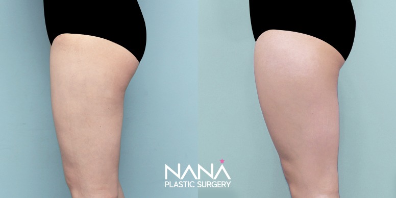 Liposuction Before & After — Before & After