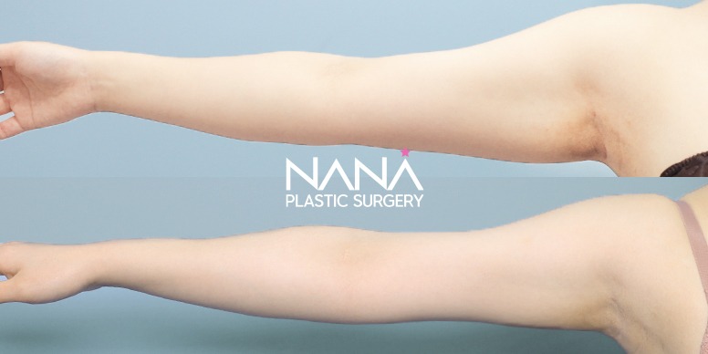 Liposuction Before & After — Before & After