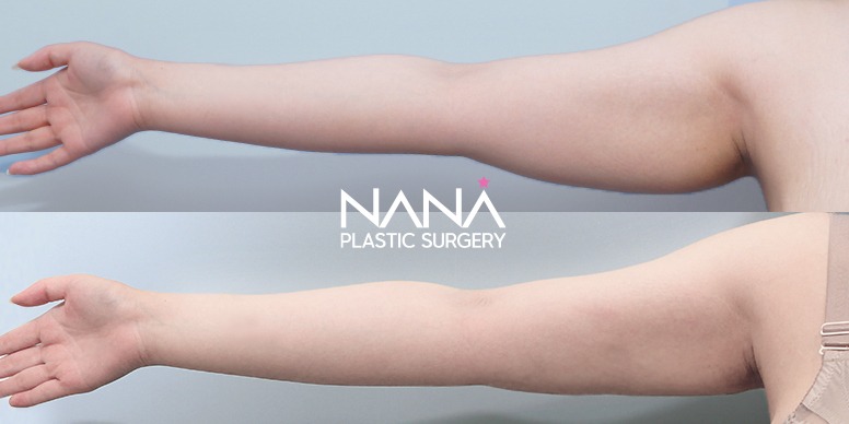 Liposuction Before & After — Before & After