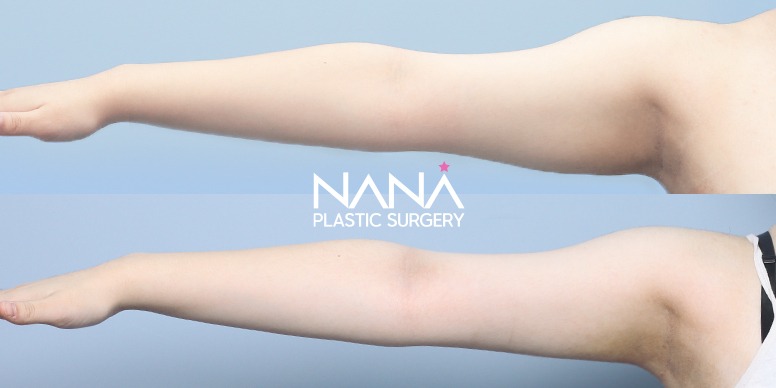Liposuction Before & After — Before & After