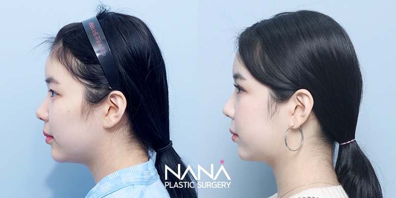 Before & After Before & After