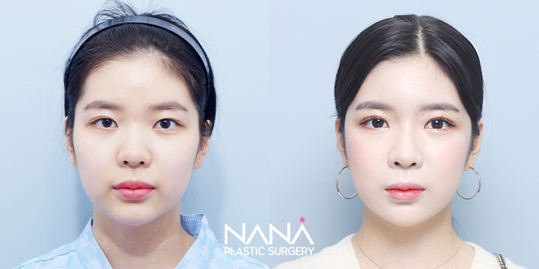 Liposuction Before & After — Before & After