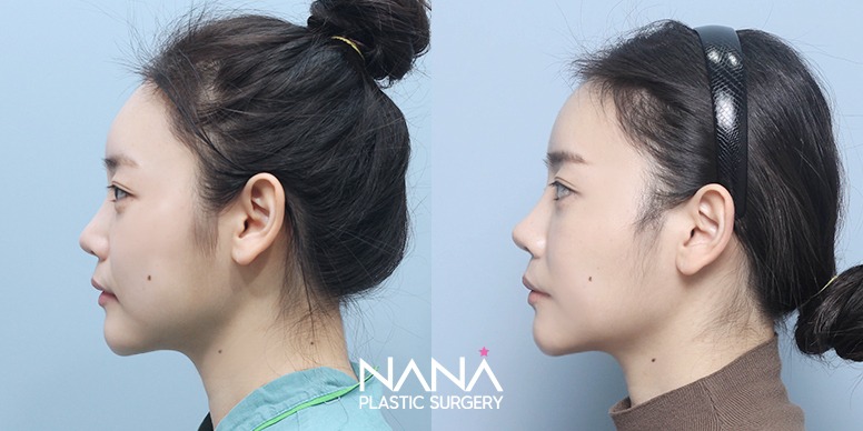 Before & After Before & After