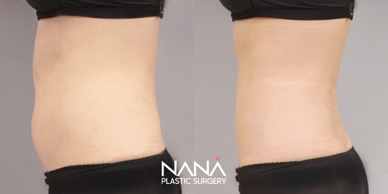 Liposuction Before & After — Before & After
