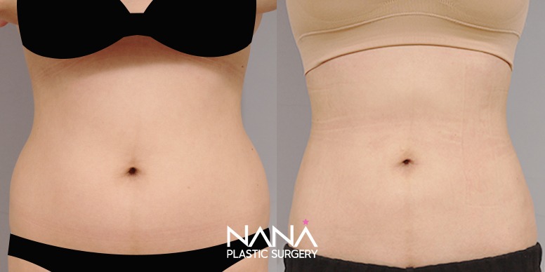 Liposuction Before & After — Before & After