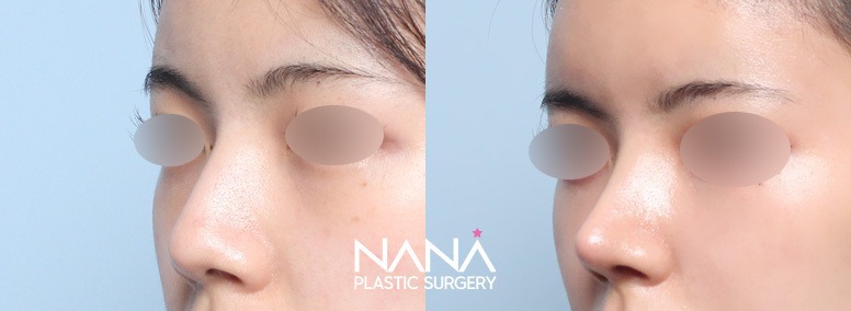 Hidung Sebelum & Sesudah — Sebelum & Sesudah