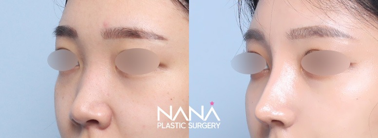 Hidung Sebelum & Sesudah — Sebelum & Sesudah