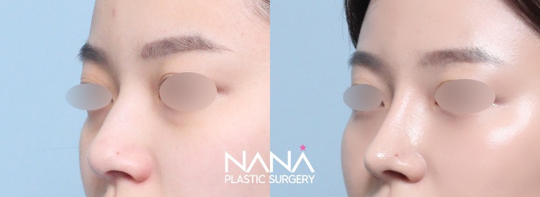 Hidung Sebelum & Sesudah — Sebelum & Sesudah