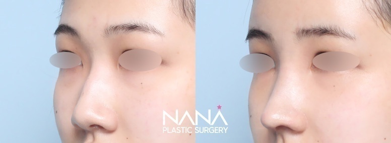 Hidung Sebelum & Sesudah — Sebelum & Sesudah