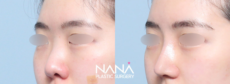 Hidung Sebelum & Sesudah — Sebelum & Sesudah