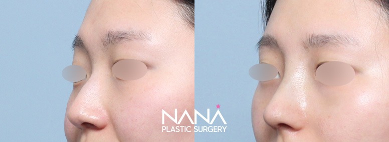 Hidung Sebelum & Sesudah — Sebelum & Sesudah