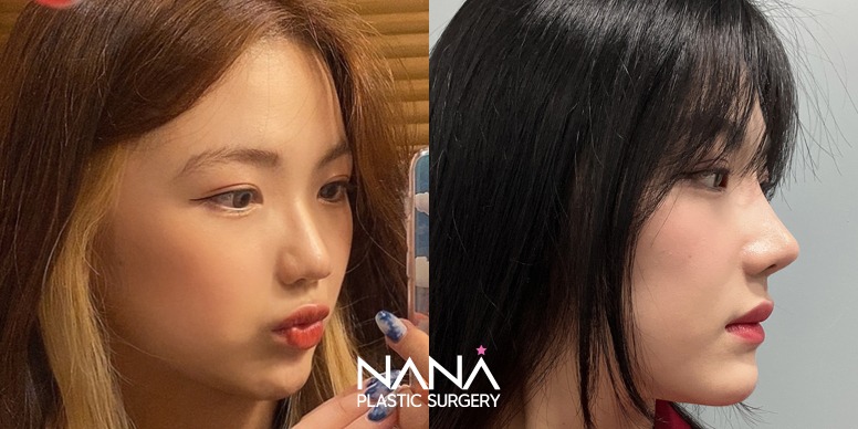 Hidung Sebelum & Sesudah — Sebelum & Sesudah