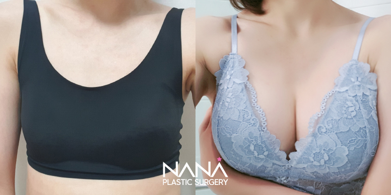 Breast Before & After — Before & After