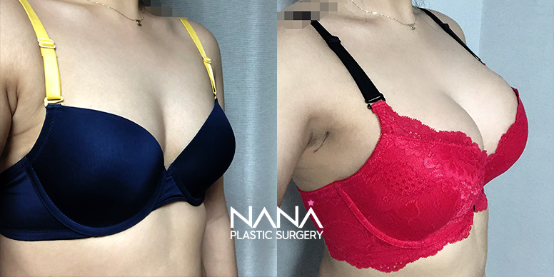 전후사진 전후사진
