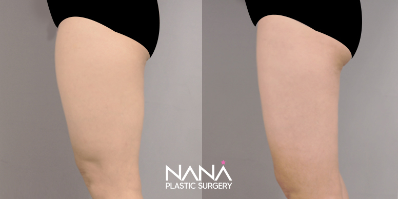 Liposuction Before & After — Before & After