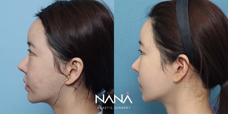 Before & After Before & After