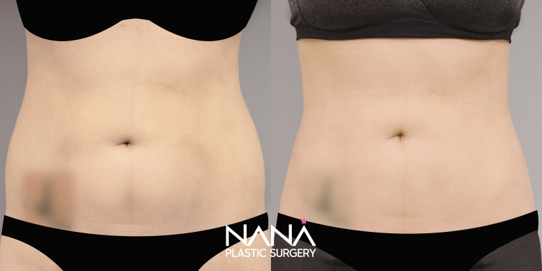 Liposuction Before & After — Before & After