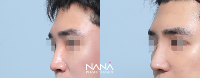 男性整形 症例写真 — 症例写真