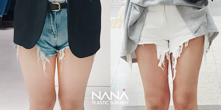 Liposuction Before & After — Before & After