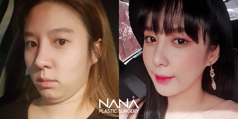 Liposuction Before & After — Before & After