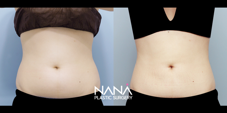 Liposuction Before & After — Before & After