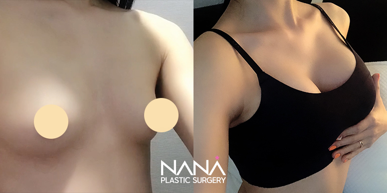 Breast Before & After — Before & After