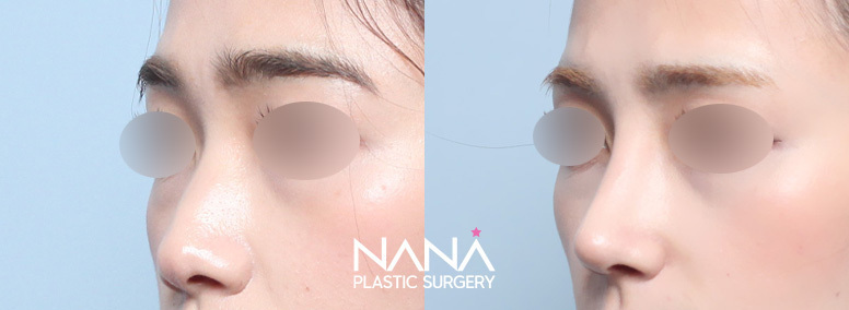 Nose Before & After — Before & After