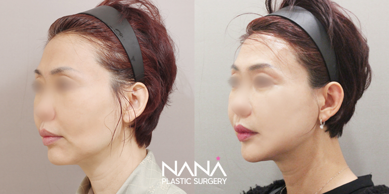 Before & After Before & After