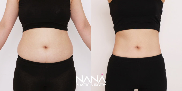 Liposuction Before & After — Before & After
