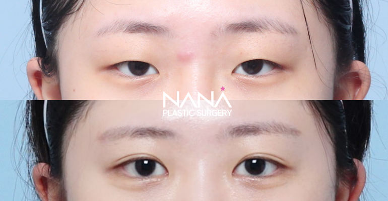 Eyes Before & After — Before & After