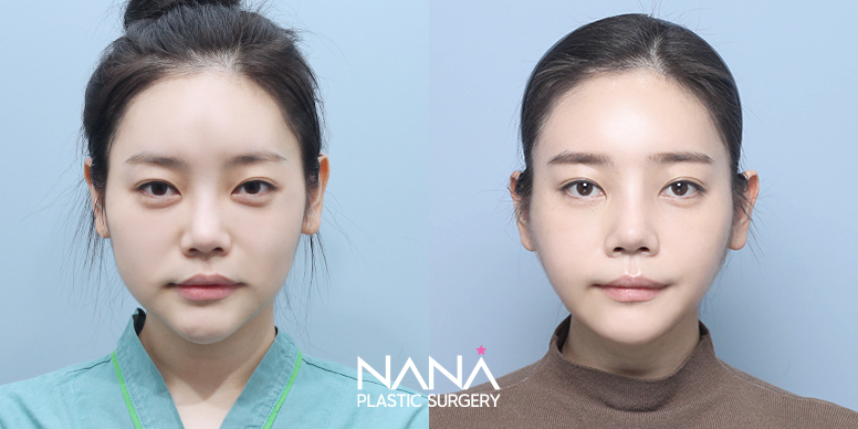 Liposuction Before & After — Before & After