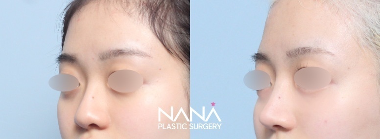 Nose Before & After — Before & After