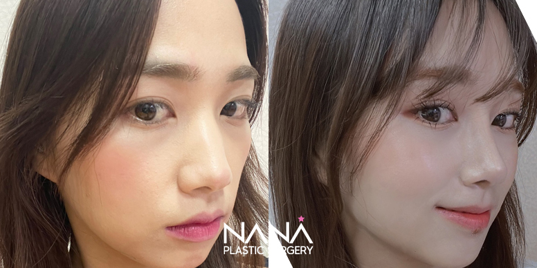 Before & After Before & After